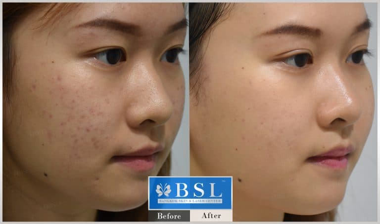capillaries-red-birthmarks-blushing-11-img