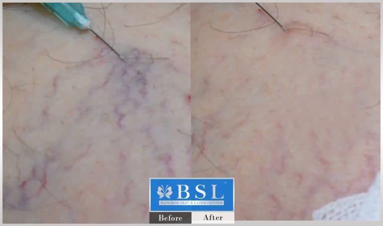 capillaries-red-birthmarks-blushing-13-img