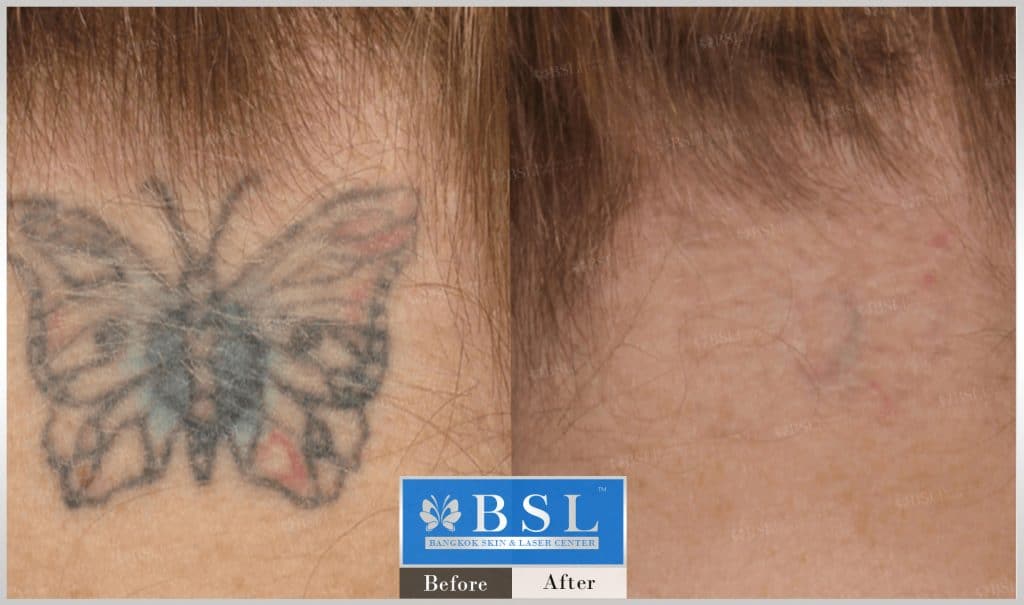 remove-tattoos-04-img