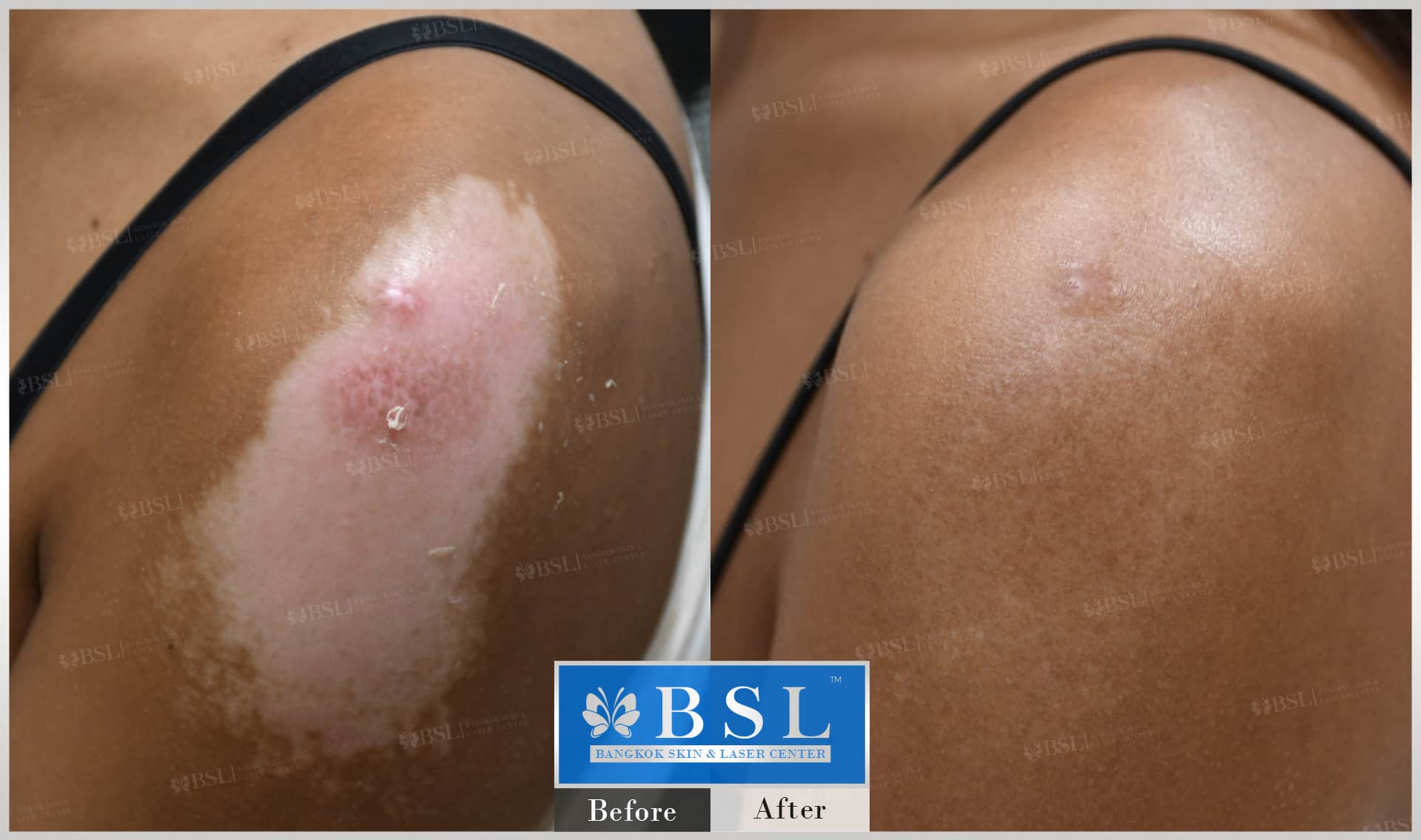 scar-treatment-13-img