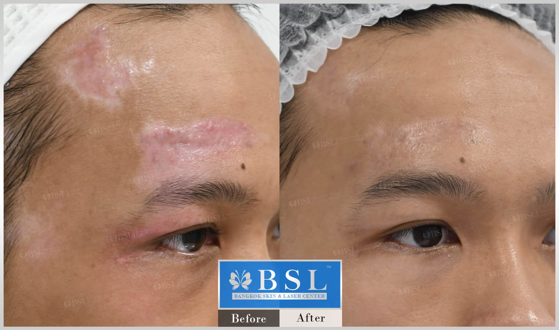 scar-treatment-14-img