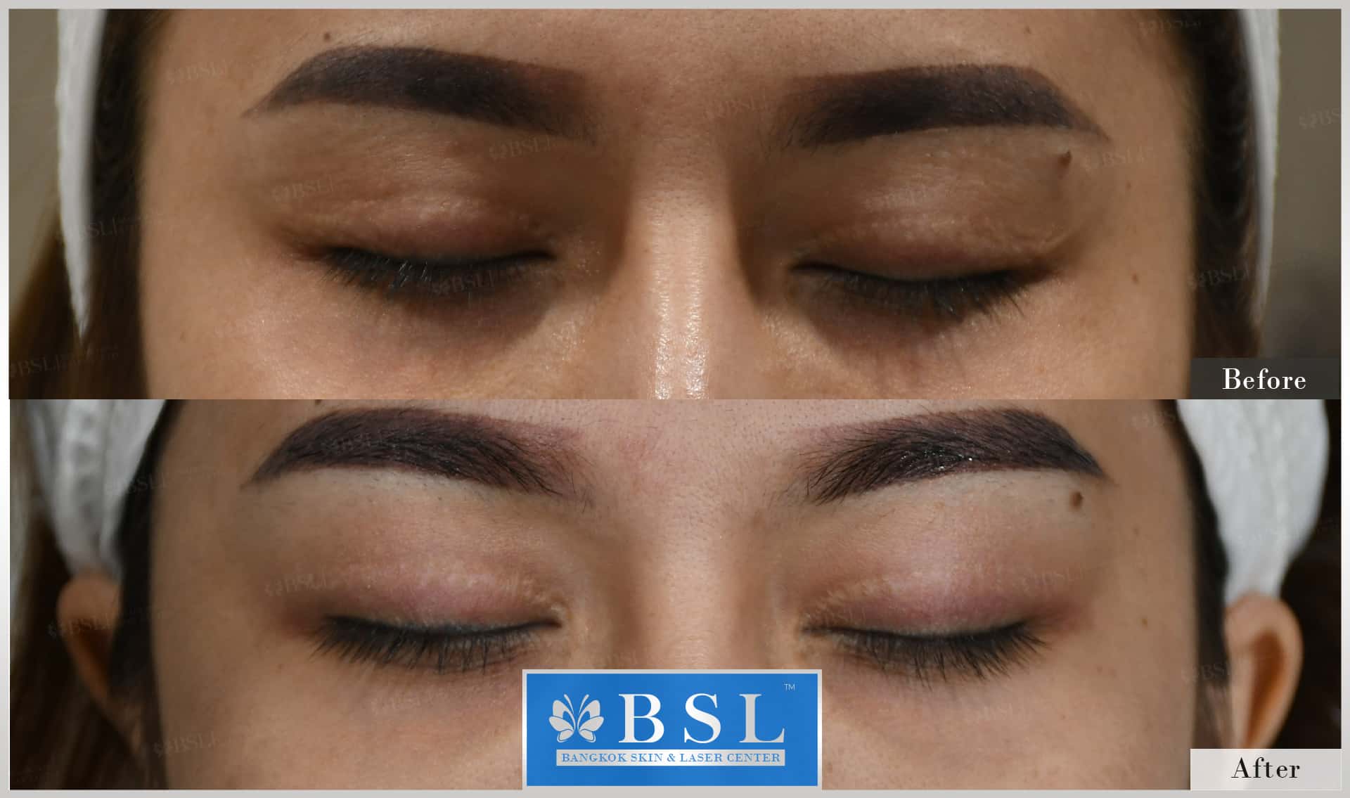 scar-treatment-15-img