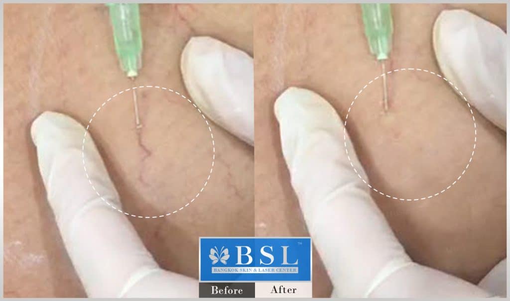varicose-veins-07-img
