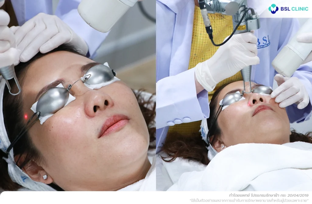 วิธีรักษาฝ้า