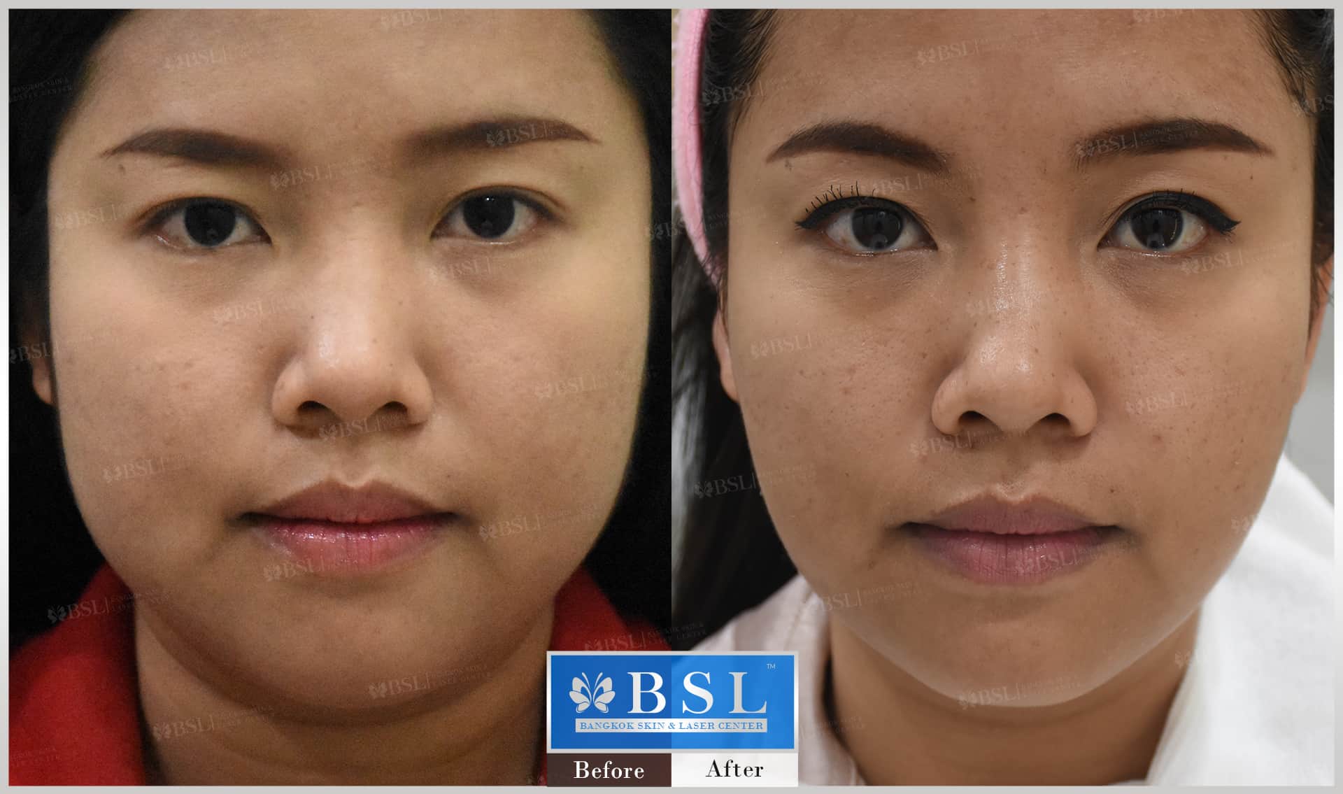 before-after-results-chin-augmentation-001