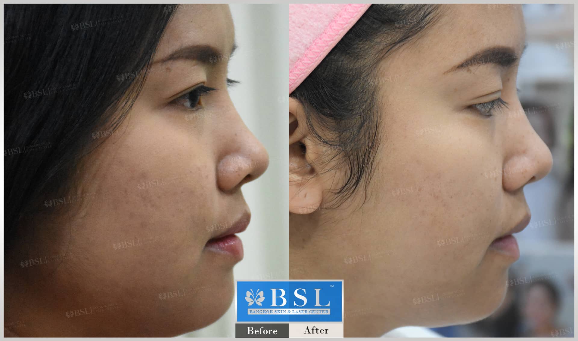 before-after-results-chin-augmentation-002