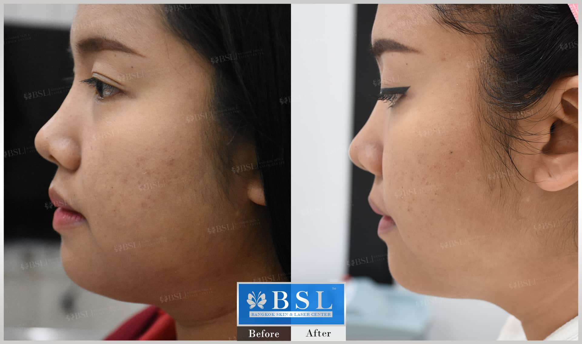 before-after-results-chin-augmentation-003