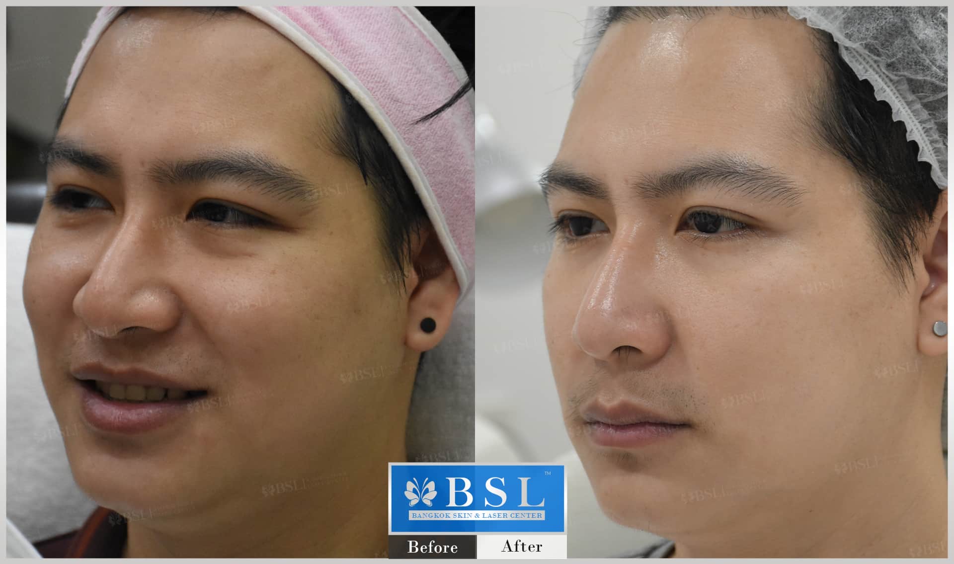 before-after-results-chin-augmentation-004