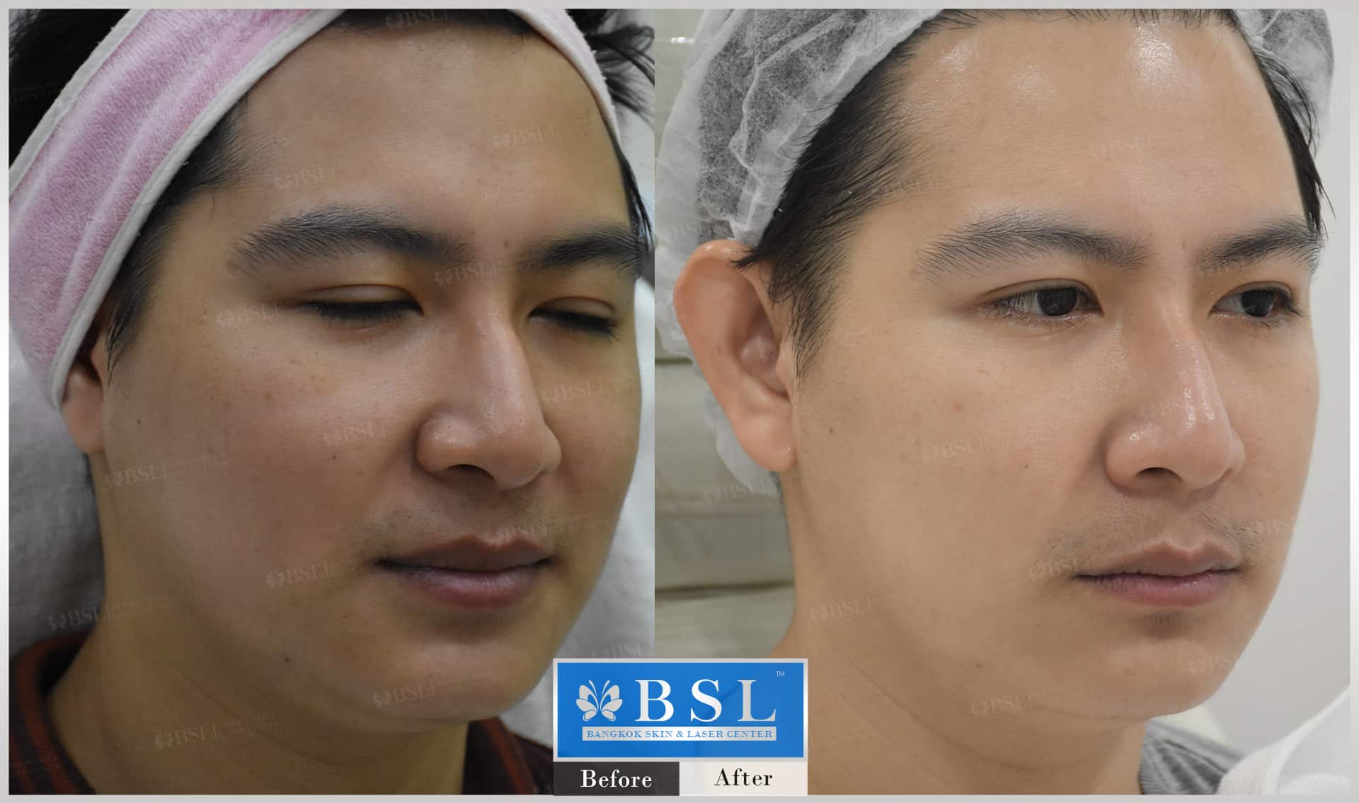 before-after-results-chin-augmentation-005