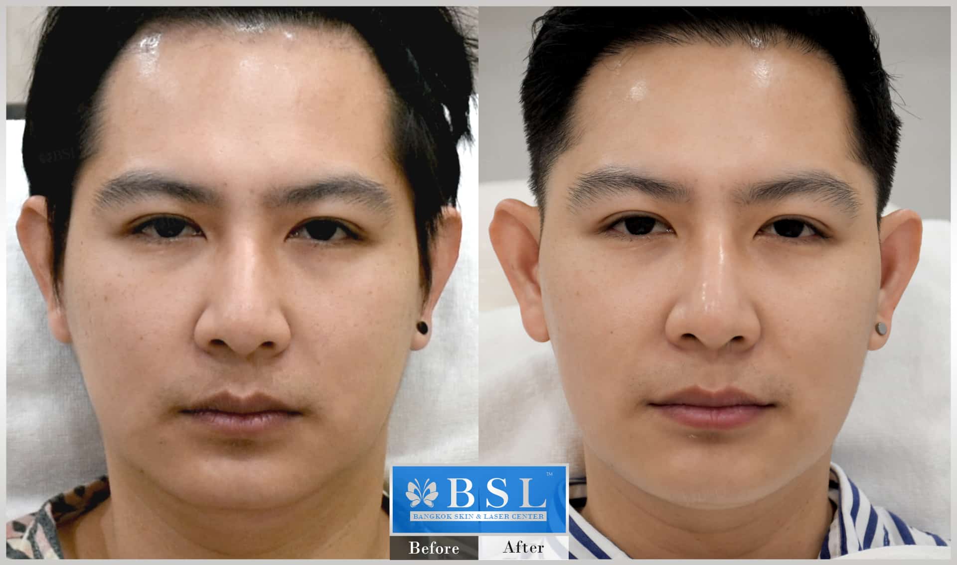 before-after-results-chin-augmentation-007
