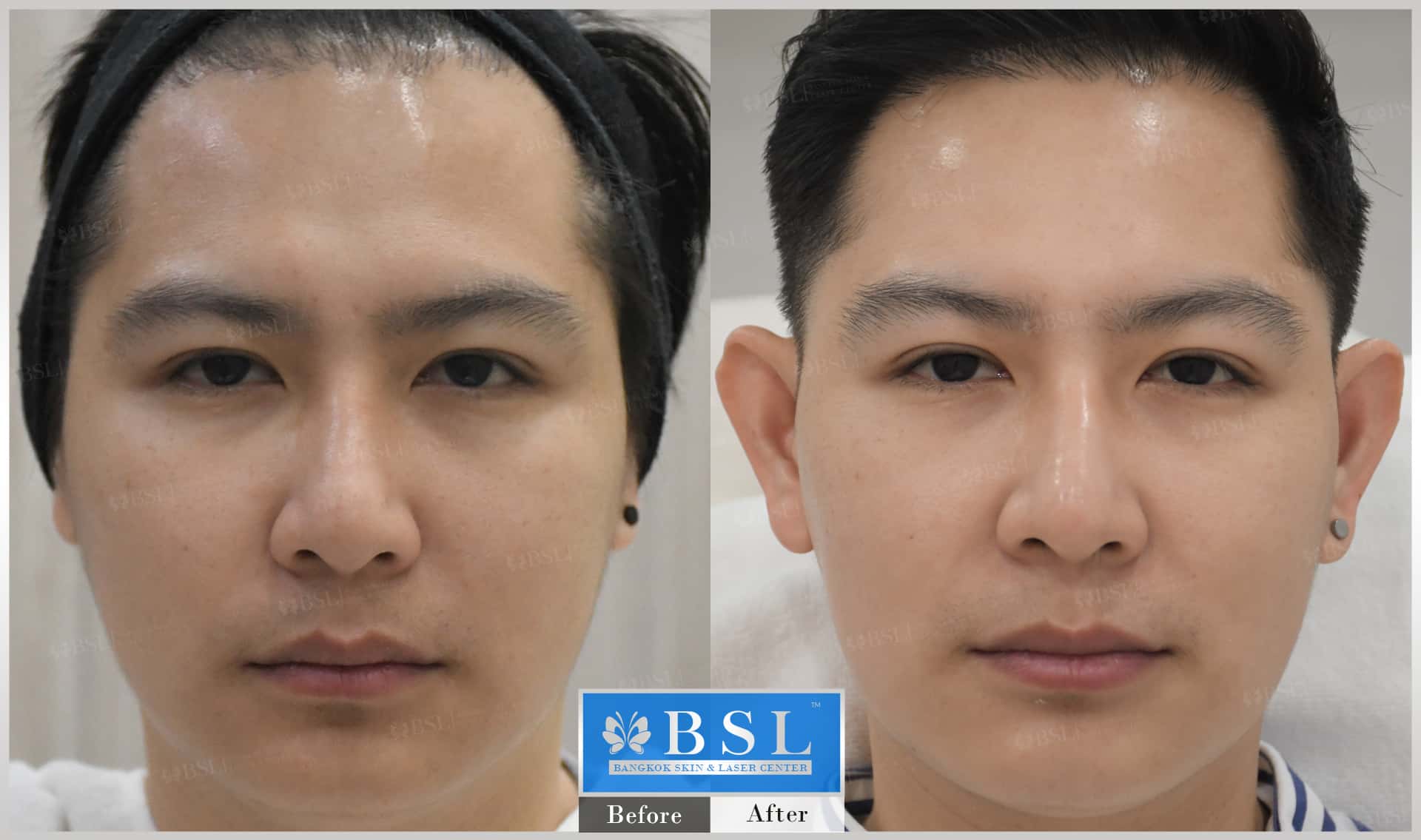 before-after-results-chin-augmentation-008