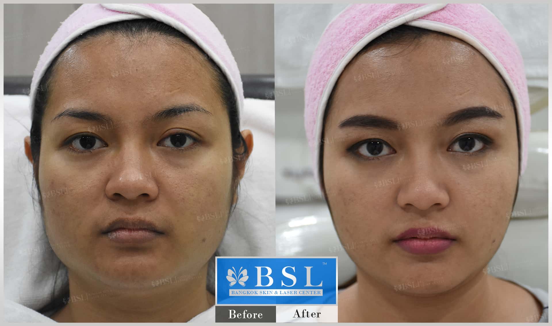 before-after-results-chin-augmentation-009