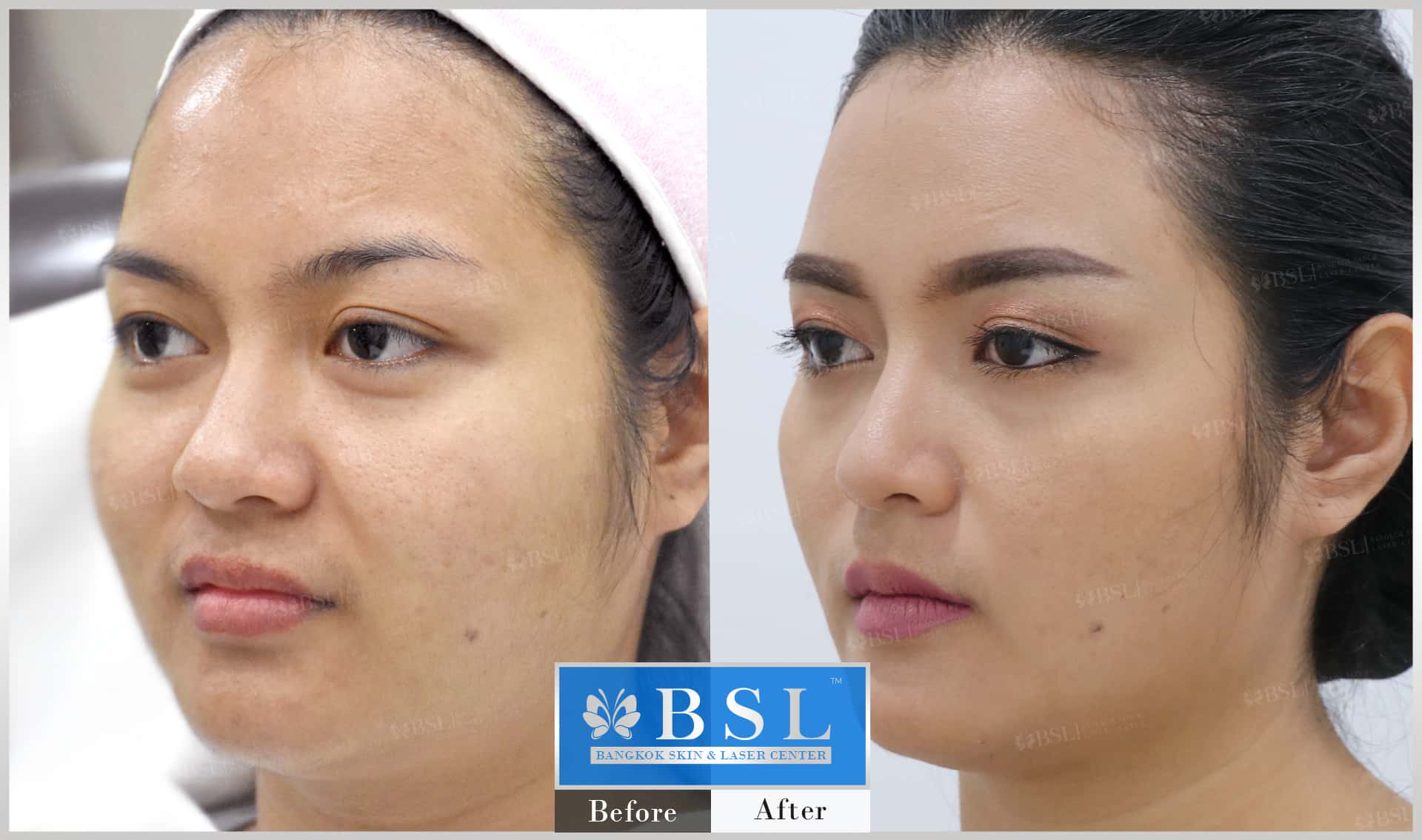 before-after-results-chin-augmentation-010