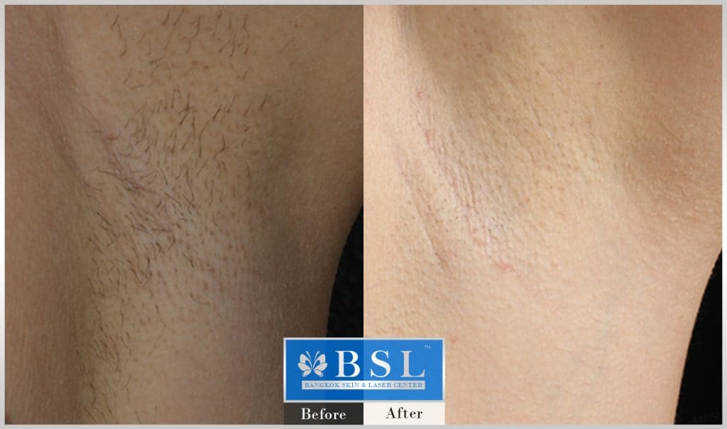 before-after-results-hair-removal-003