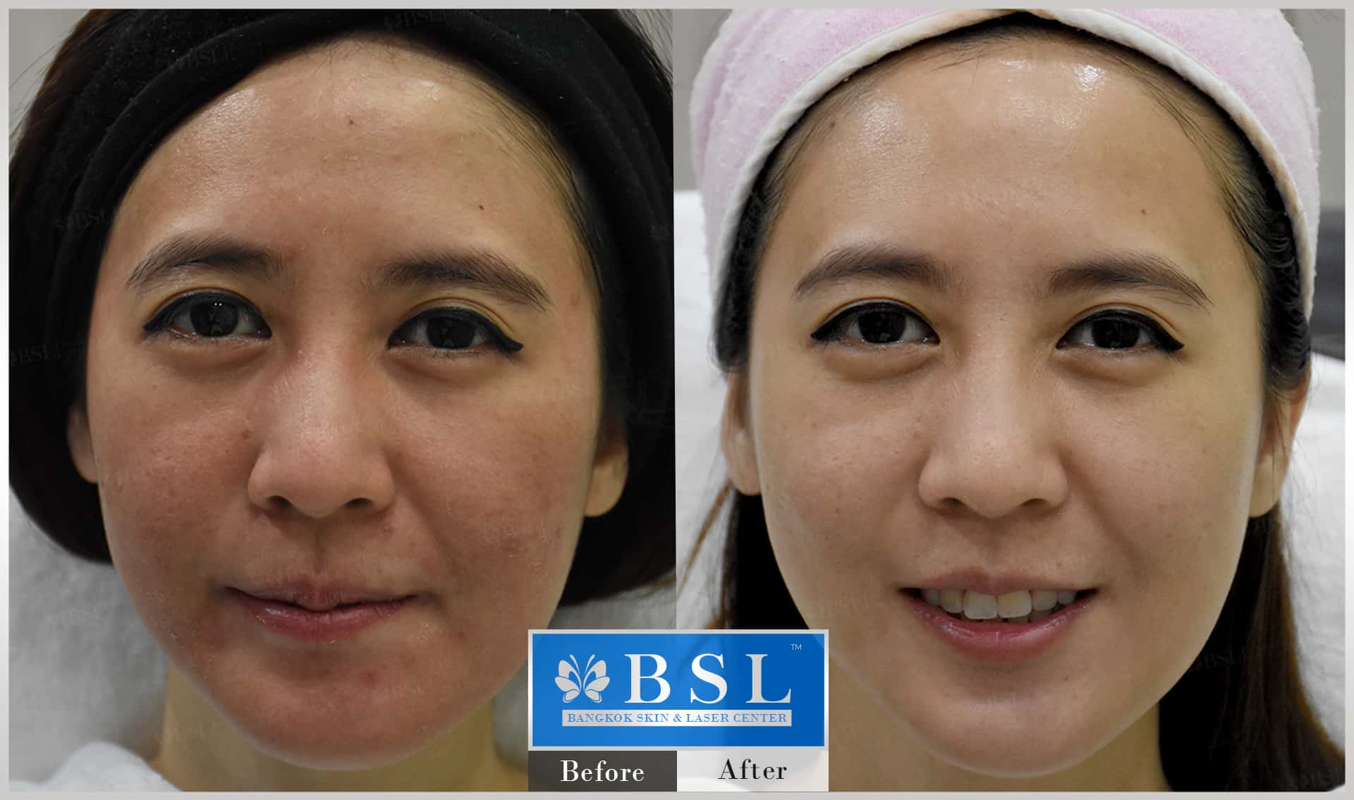 before-after-results-sensitive-skin-004