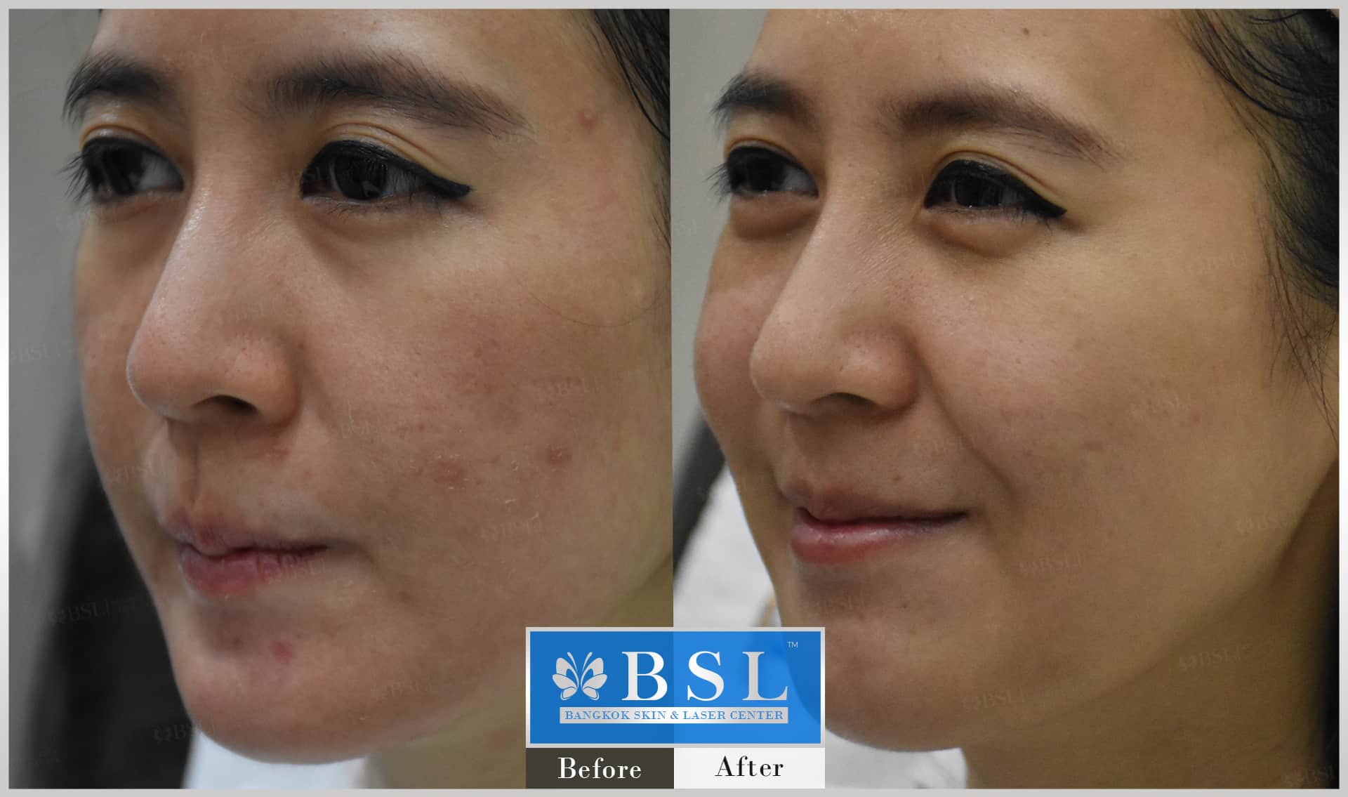before-after-results-sensitive-skin-005