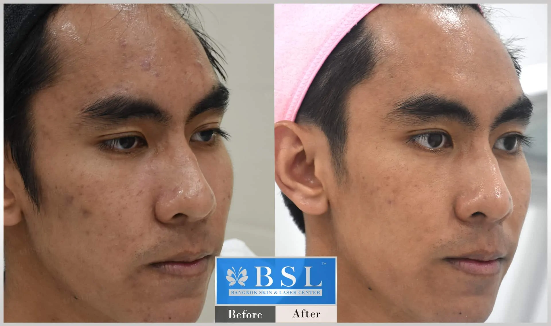 before-after-results-sensitive-skin-008