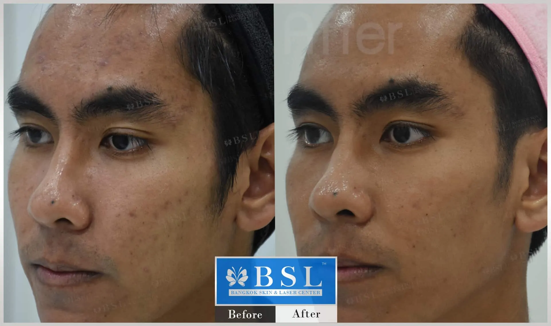 before-after-results-sensitive-skin-010