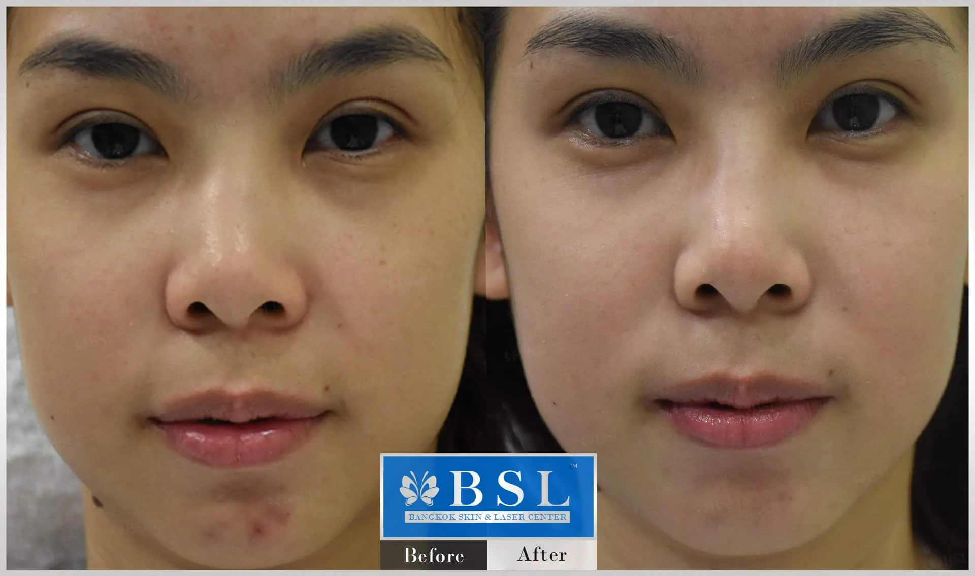 before-after-results-sensitive-skin-011
