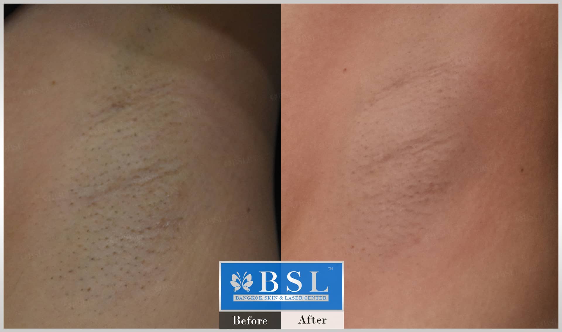 before-after-results-smooth-white-armpits-001