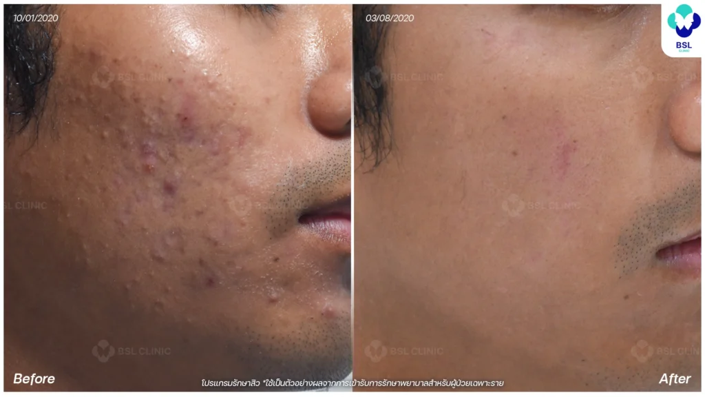 คุณมั่นรัก รีวิวรักษาสิวกับ BSL Clinic