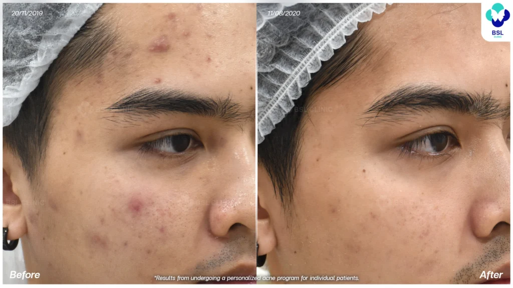 โปรแกรมรักษาสิว-คุณชานนท์
