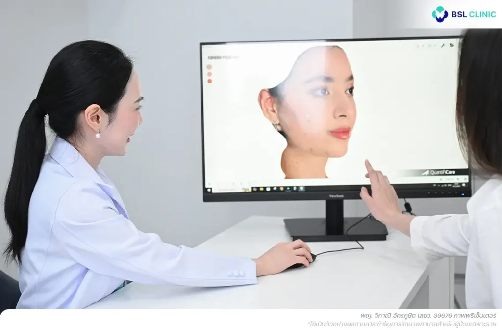 ปรึกษาแพทย์ก่อนเลเซอร์รักษาสิว