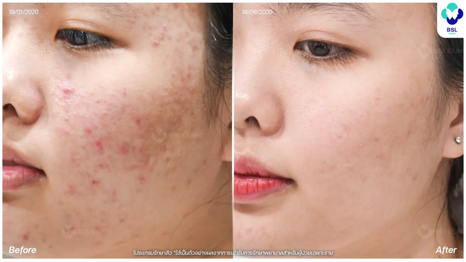 รีวิวการรักษาสิวกับ BSL