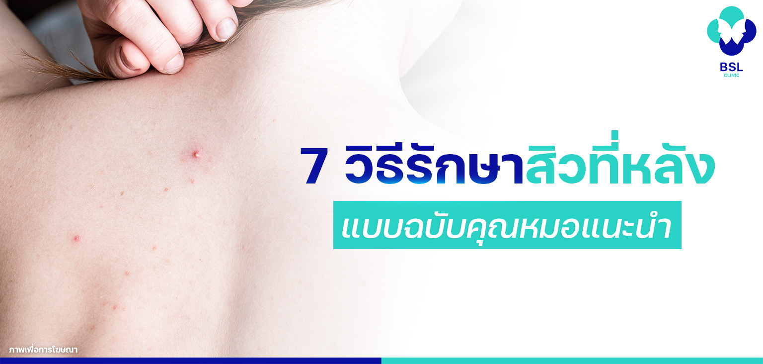 banner-7-วิธีรักษาสิวที่หลัง-แบบฉบับคุณหมอแนะนำ
