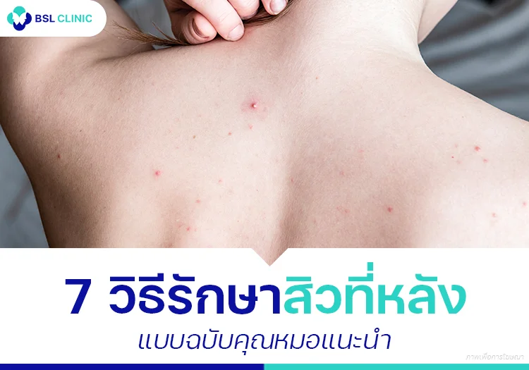 รักษาสิวที่หลัง