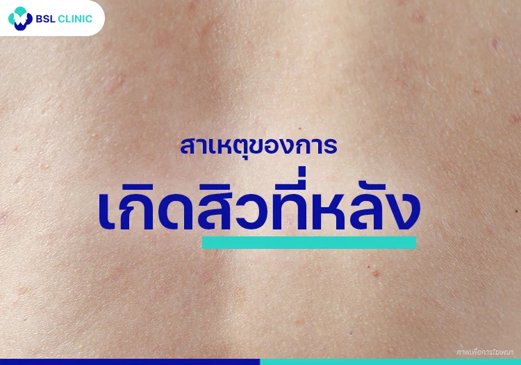 รักษาสิวที่หลัง