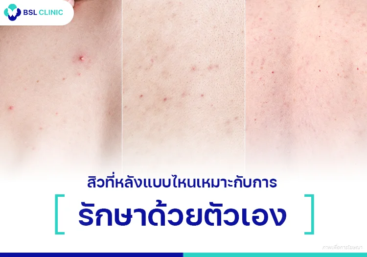 รักษาสิวที่หลัง