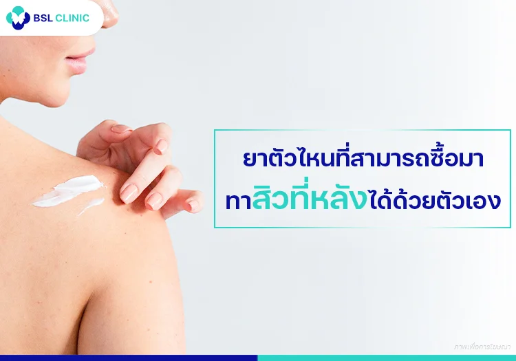 รักษาสิวที่หลัง