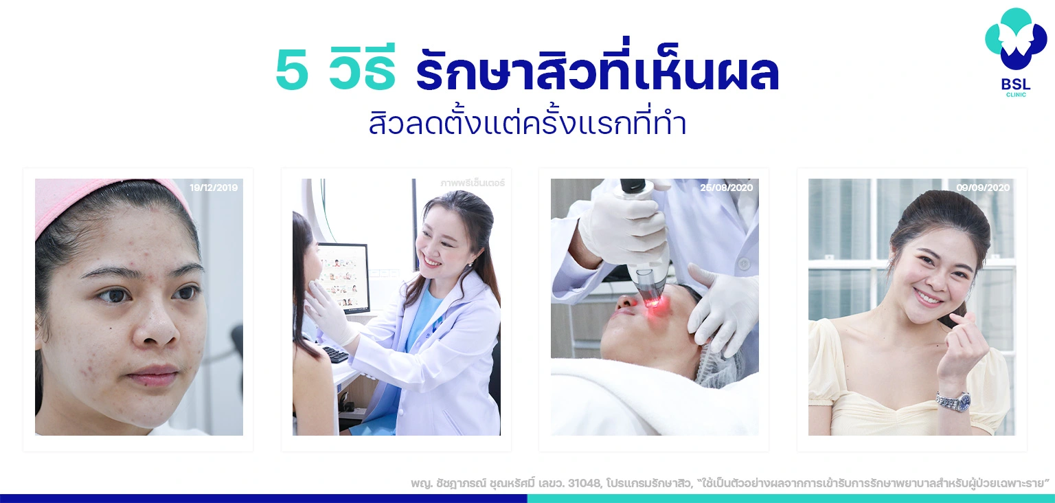 5-วิธี-รักษาสิวที่เห็นผล-สิวลดตั้งแต่ครั้งแรกที่ทำ