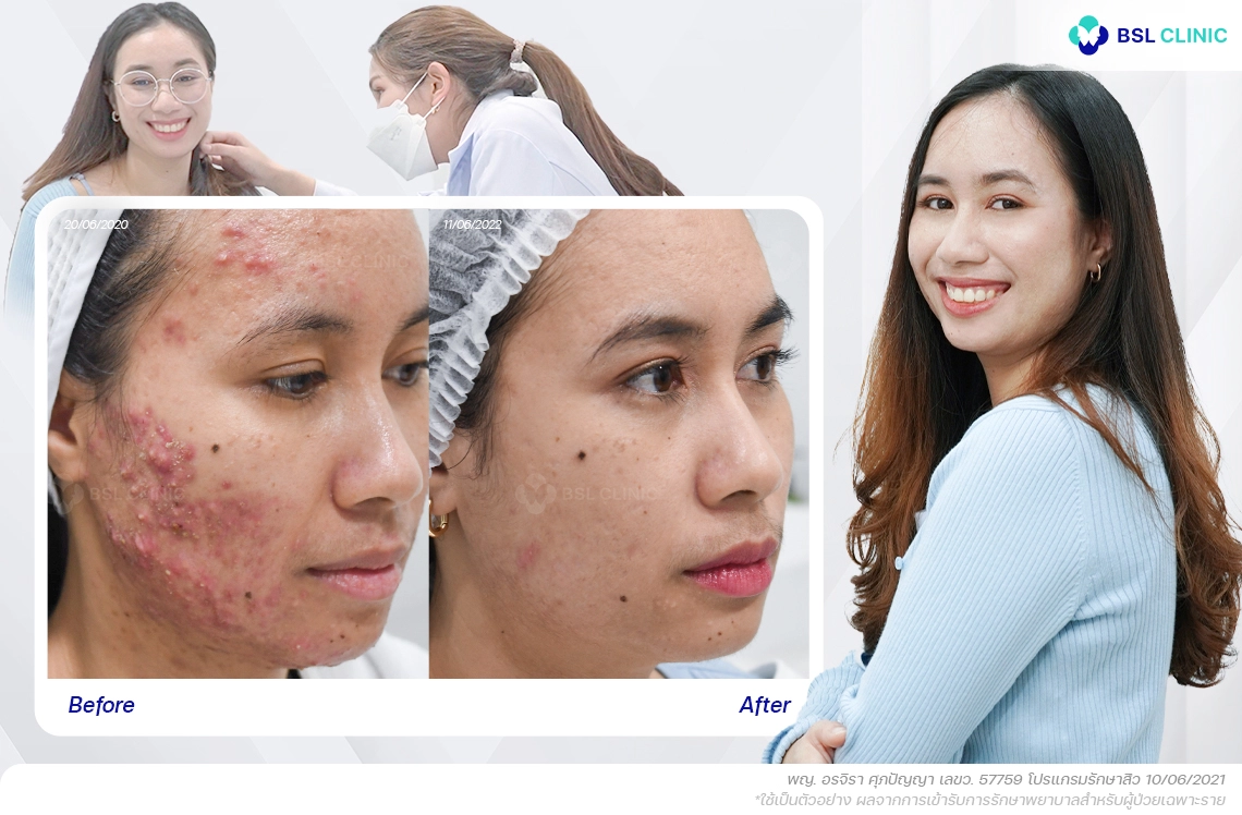 รีวิว-สิวอักเสบ-630134-A-เมธปิยา-edit