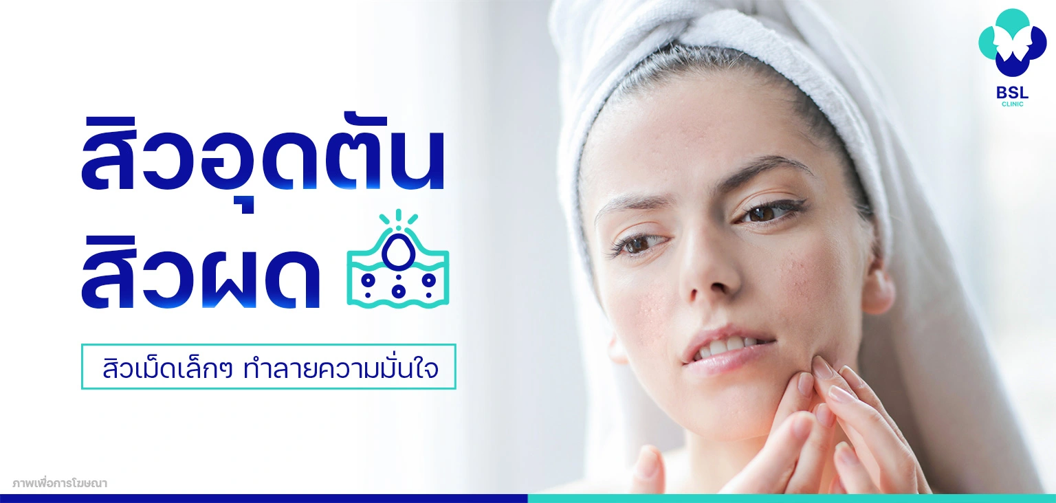 สิวอุดตัน สิวผด