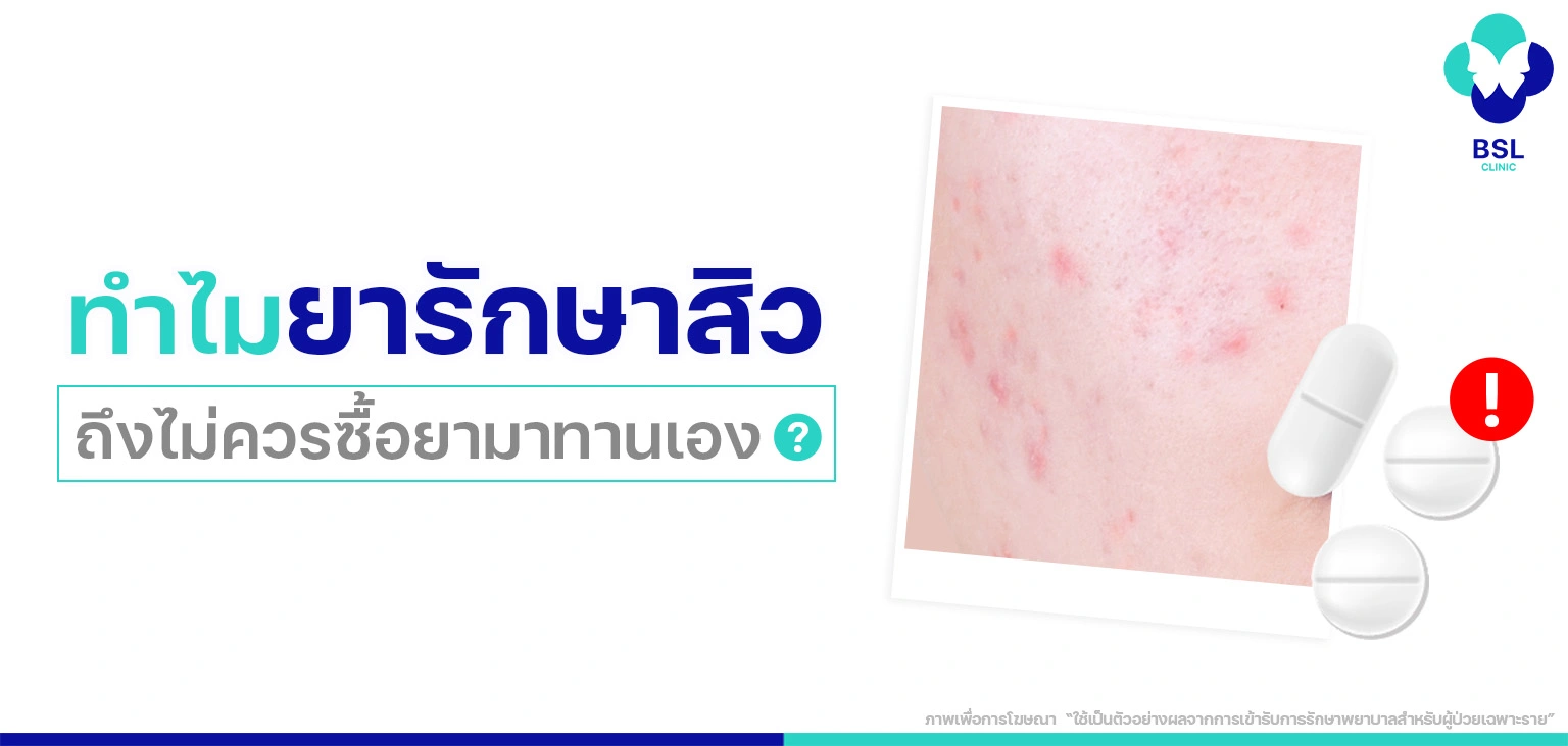 ทำไมยารักษาสิว คนไข้ไม่ควรซื้อกินเอง