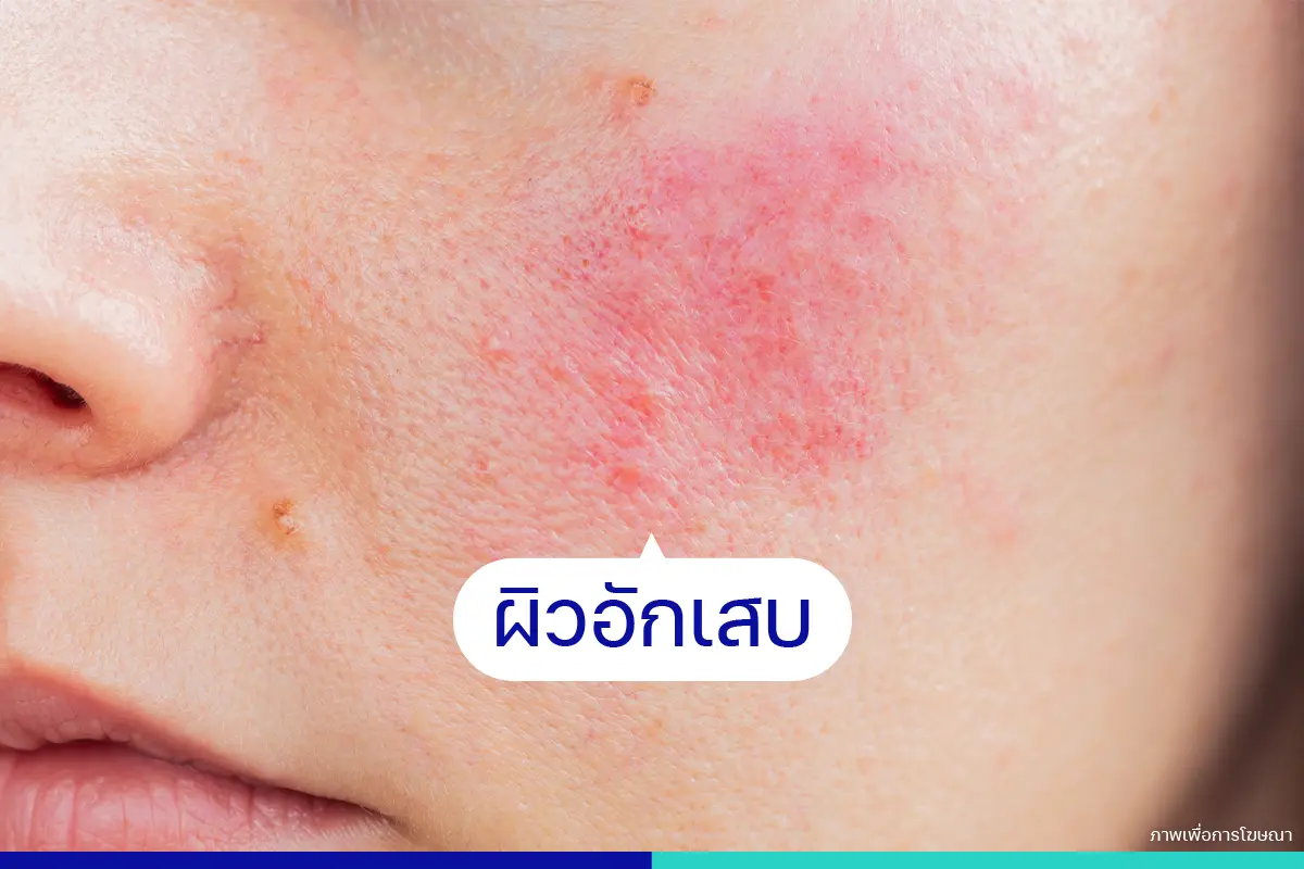 ซื้อยารักษาสิวเอง ทำให้ผิวอักเสบได้