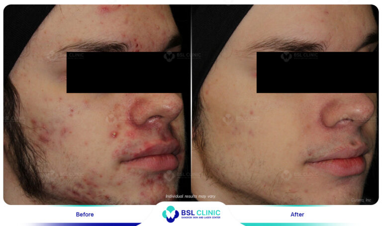Result-AviClear-Before-After