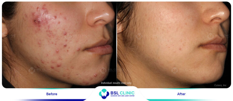 Result-AviClear-Before-After
