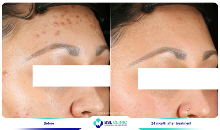 ผลการรักษาสิว-accure-laser-bslclinic