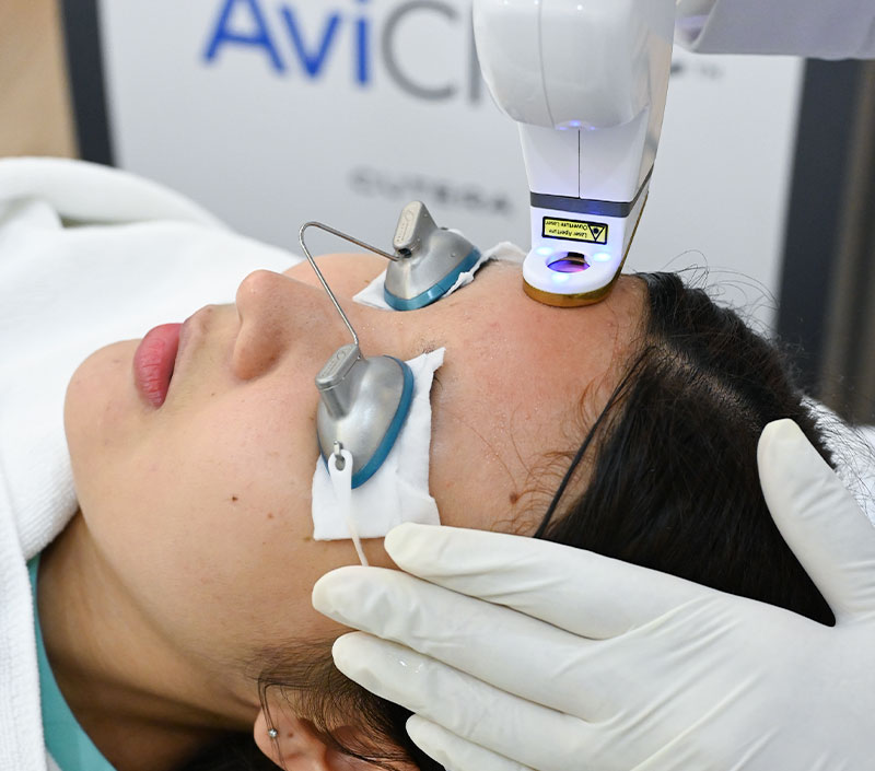 AviClear-Laser-at-BSL-Clinic-เลเซอร์รักษาสิว