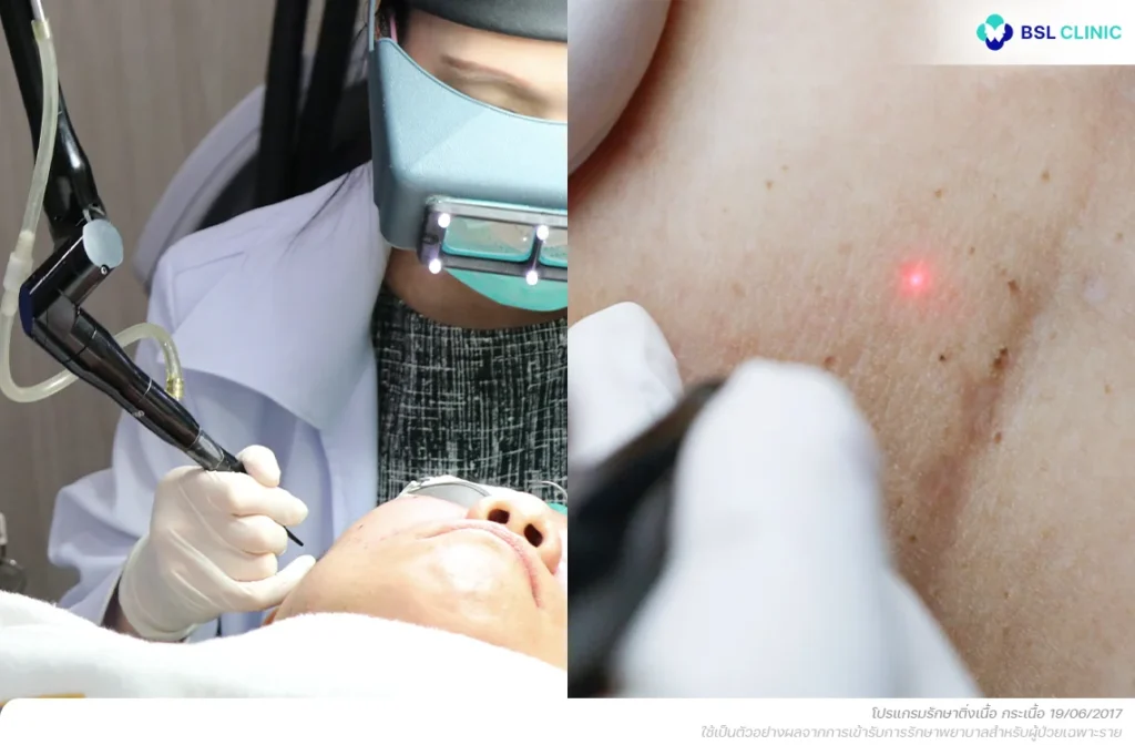 CO2-เลเซอร์-ติ่งเนื้อ-กระเนื้อ