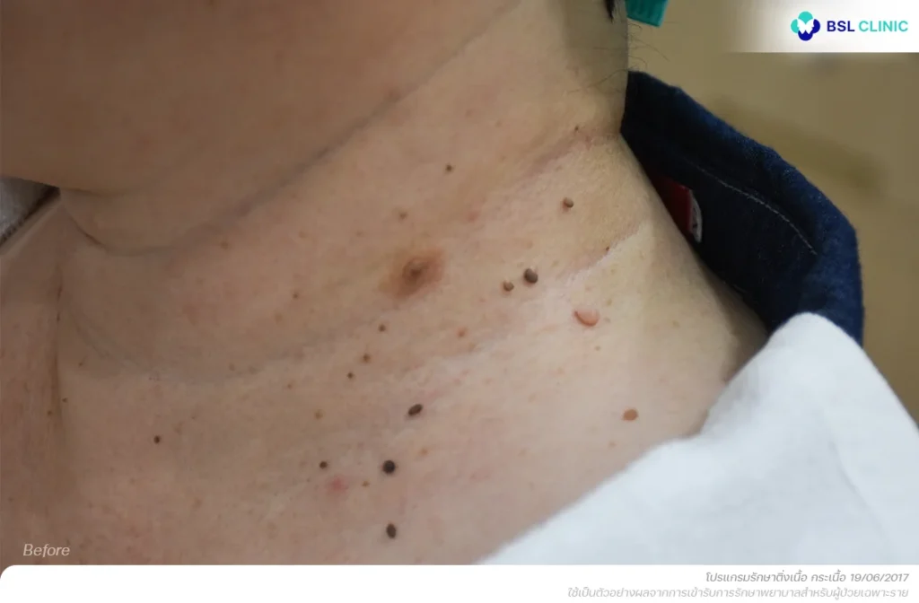 ก่อนรักษา-เลเซอร์-ติ่งเนื้อ-กระเนื้อ