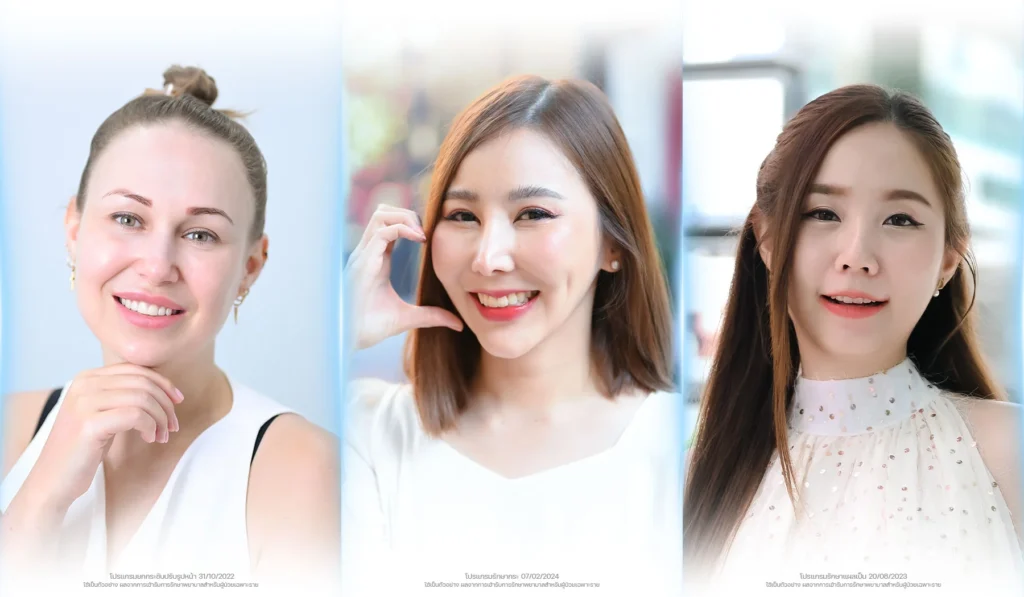 รีวิวคนไข้จริง-bslclinic-สิว-ฝ้า-กระ-ไฝ-แผลเป็น