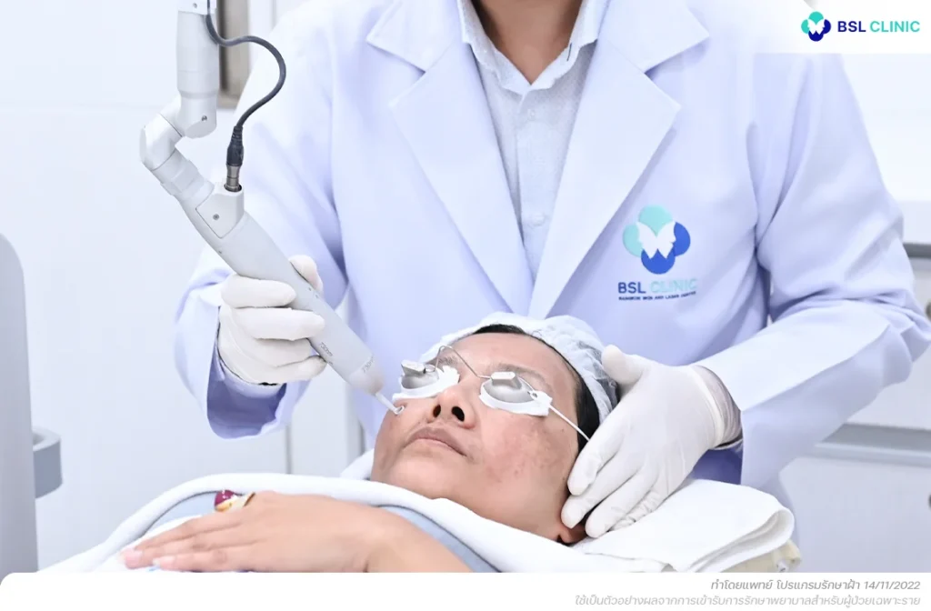 เลเซอร์ลดเม็ดสีฝ้า PicoWay 250ps รักษาฝ้ากระ