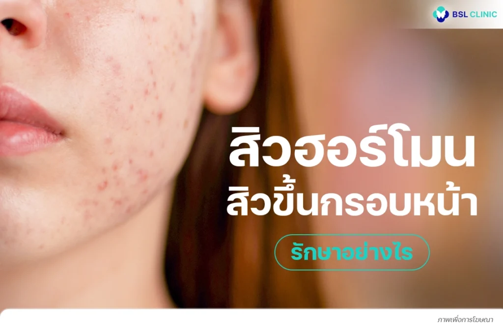 สิวฮอร์โมน คืออะไร รักษาสิวขึ้นคางอย่างไร ให้หน้ากลับมาใสผิวแข็งแรง