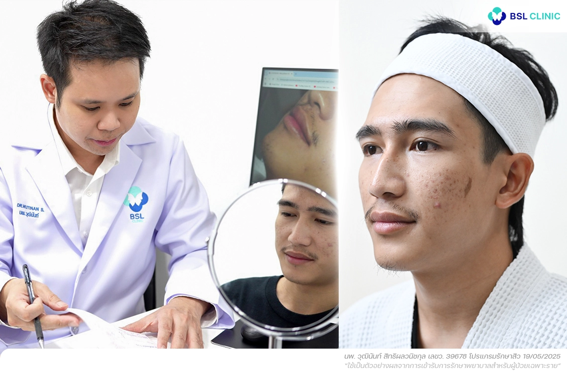 คลินิกรักษาสิวในกรุงเทพ รีวิวสิว