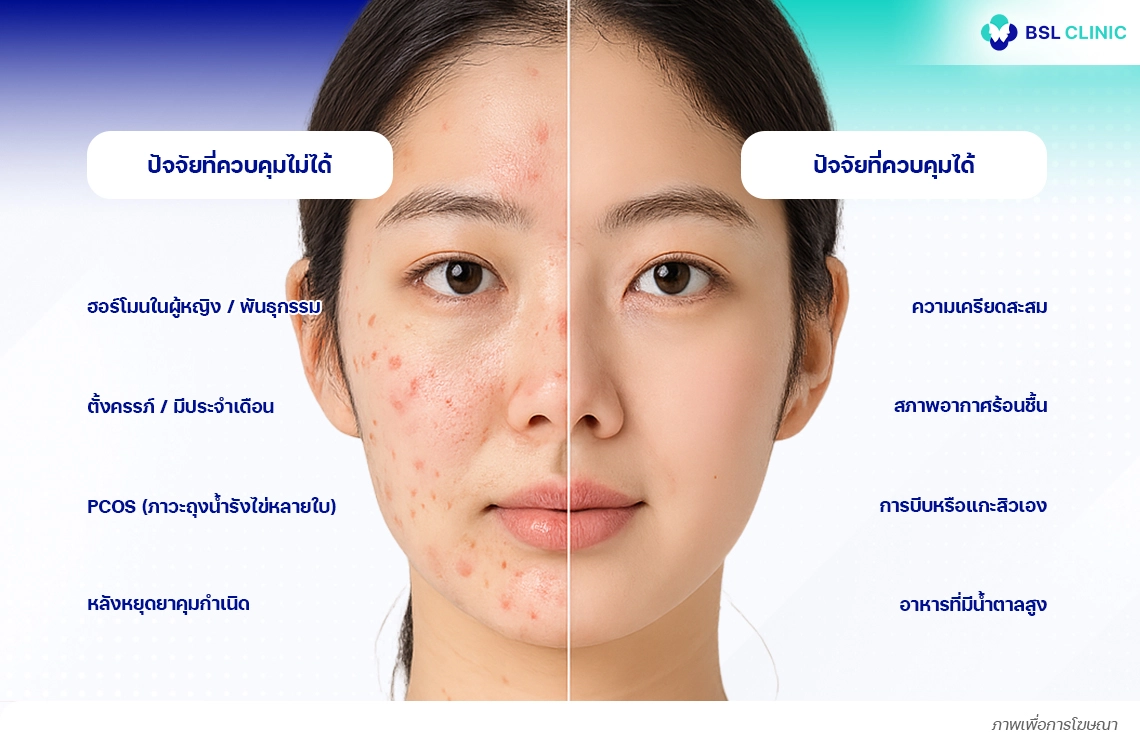 สาเหตุของการเกิดสิวฮอร์โมน