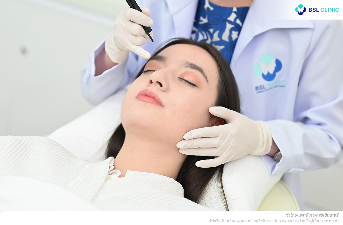 สิวฮอร์โมน เทคนิคเปิดหัวสิวด้วย CO2 Laser